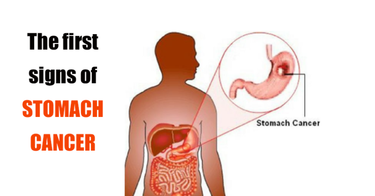 Cᴀɴᴄᴇʀ in the stomach develops silently. These are the first signs! You should be attentive!