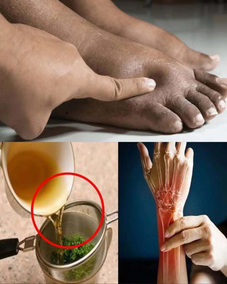 Drink This Tea & Say Goodbye to Swollen Legs, Ankles & Feet!